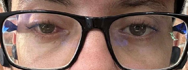 1 week after strabismus surgery - healing