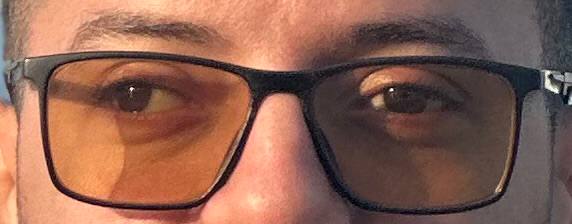 Before strabismus surgery - eye with exotropia